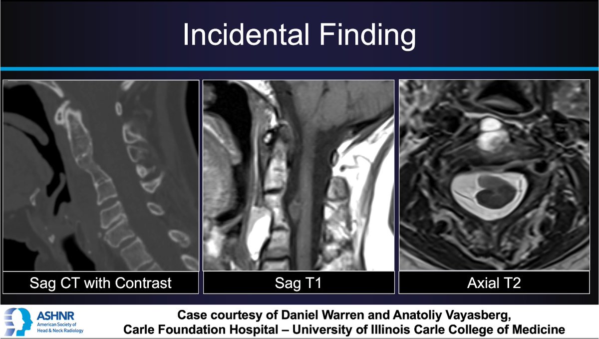 ASHNR (@ashnrsociety) on Twitter photo #ASHNRCOTW 313: Incidental Finding. Thx Drs. Warren + Vayasberg 4 case! #ASHNR25
Answer w/ appropriate GIF only -- stay professional & don't spoil it!
<a href="/callyrobs/">Caroline Robson, MBChB</a> <a href="/DShatzkes/">Deborah Shatzkes</a> <a href="/CDP_Rad/">C Douglas Phillips 🇺🇸</a> <a href="/rhwiggins/">Richard Wiggins</a>
<a href="/nakoontz/">Nicholas Koontz</a> <a href="/KRileyMD/">Kalen Riley</a> <a href="/CMGlastonbury/">Christine M Glastonbury, MD</a>
<a href="/tabby_kennedy/">Tabby A. Kennedy, MD</a> #ASHNRCOTW 313: Incidental Finding. Thx Drs. Warren + Vayasberg 4 case! #ASHNR25
Answer w/ appropriate GIF only -- stay professional & don't spoil it!
<a href="/callyrobs/">Caroline Robson, MBChB</a> <a href="/DShatzkes/">Deborah Shatzkes</a> <a href="/CDP_Rad/">C Douglas Phillips 🇺🇸</a> <a href="/rhwiggins/">Richard Wiggins</a>
<a href="/nakoontz/">Nicholas Koontz</a> <a href="/KRileyMD/">Kalen Riley</a> <a href="/CMGlastonbury/">Christine M Glastonbury, MD</a>
<a href="/tabby_kennedy/">Tabby A. Kennedy, MD</a>