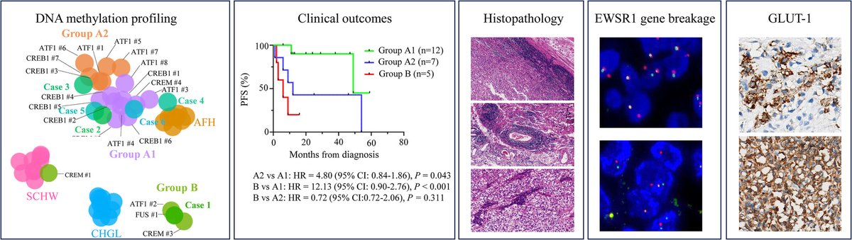 brainpathol's tweet image. Identification of a distinct epigenetic subgroup with inferior PFS in intracranial mesenchymal tumors with FET::CREB fusion
onlinelibrary.wiley.com/doi/10.1111/bp…