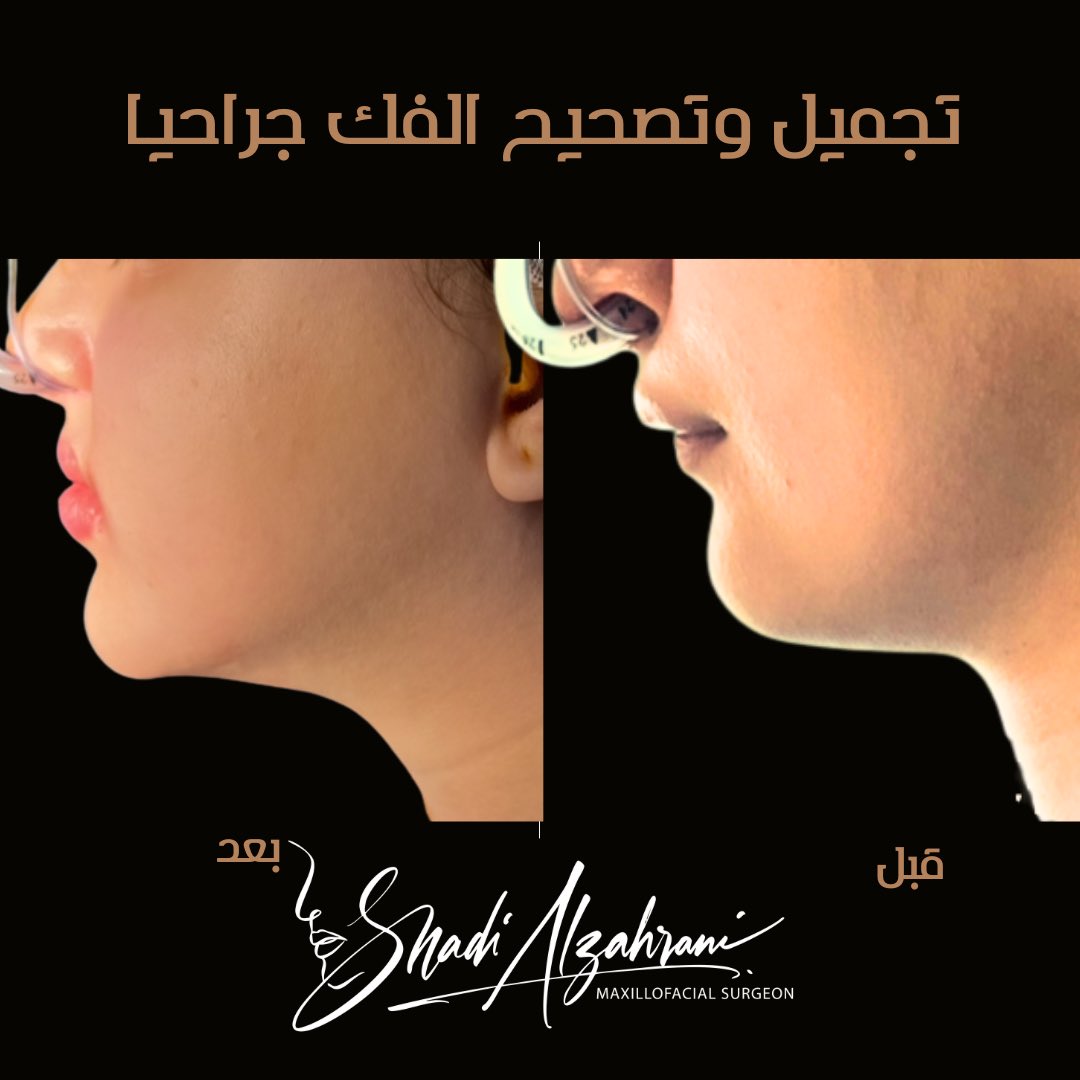ملامح أوضح، بروفايل أجمل 👌

ببساطة عملية واحده

  #تجميل #الوجه #تجميل_الوجه #التقويم