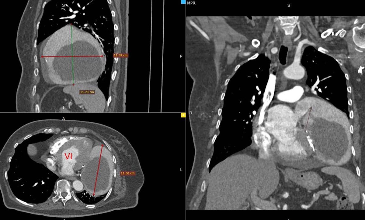 NUEVO Caso publicado en RETICweb
Aneurisma de la orejuela izquierda, la importancia de la evaluación multimodal
📙 buff.ly/O7zgR4l ◀️
#aprendeconcasos