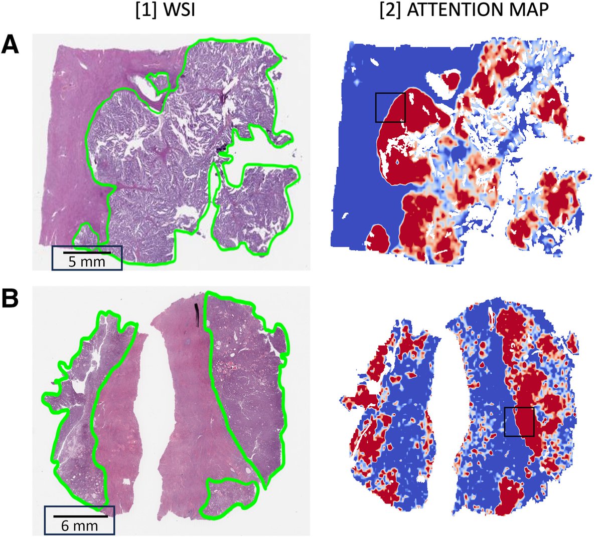 AJPathology's tweet image. #LegacyContent: #DeepLearning for Grading Endometrial Cancer.  Authors from @Dartmouth, @DartmouthHealth
Free in the #OpenArchive: ajp.amjpathol.org/article/S0002-…
