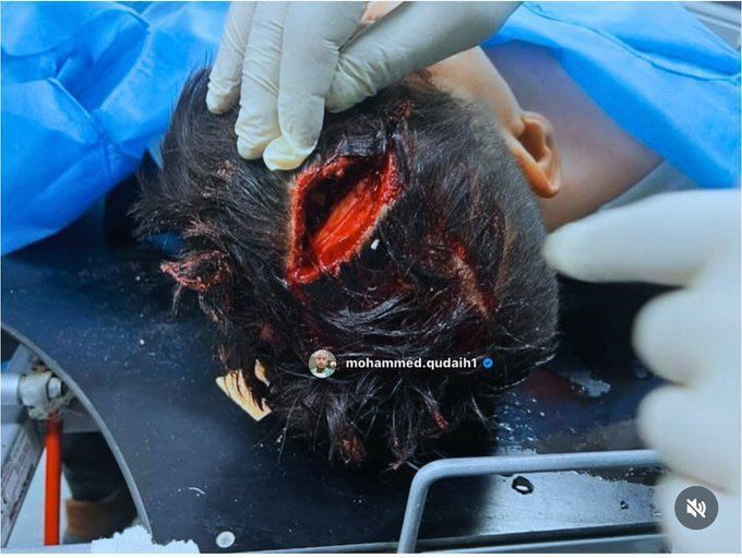 محتوى حساس 
 مشهد صادم من داخل أحد مستشفيات غزة يُظهر رأس طفل بين الضحايا، في صورة تجسّد حجم الإصابات المروّعة التي خلّفتها شظايا صواريخ الاحتلال الإسرائيلي.