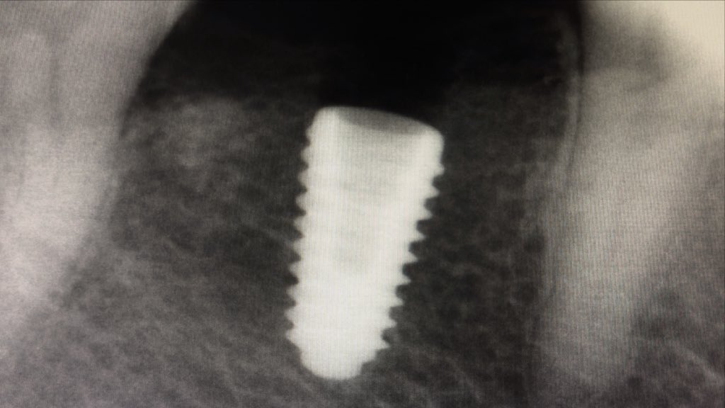 3rdSET_CE's tweet image. Day 2 at the live surgery center — today’s milestone: the first implant placement. Precision, focus, and real learning in action.
#3rdsetce #implanttraining #dentistrylife #dentalimplants #surgeryday