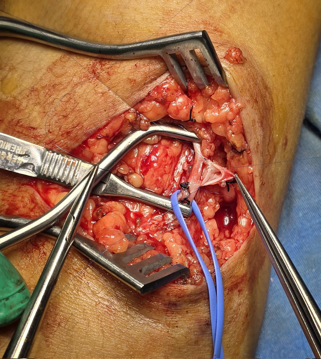 🔵Subclavian vein angioplasty + 🔴🔵Arteriovenous fistula creation