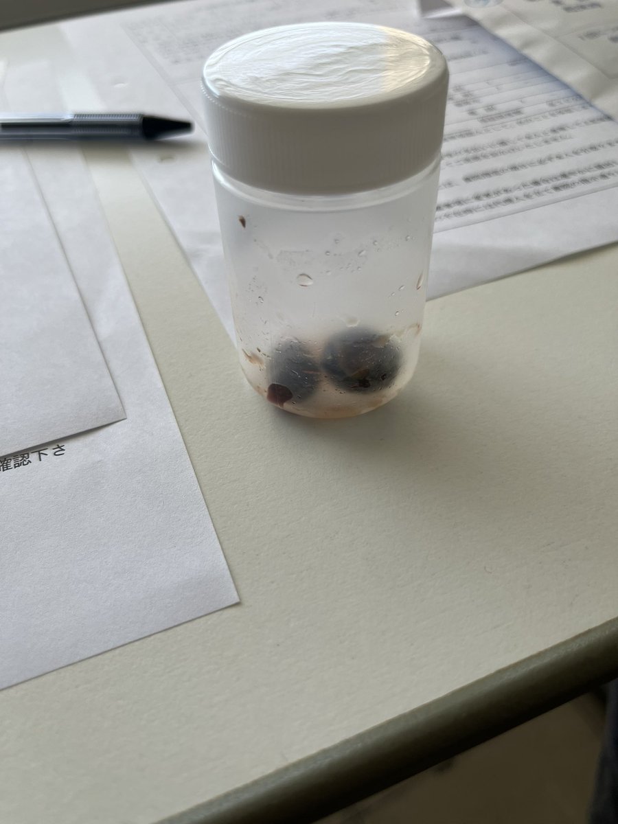 やばい腹痛がきて翌日診察で、胆のう結石が見つかってクソデカ石が取れました。
このサイズはさすがに詰まるわ