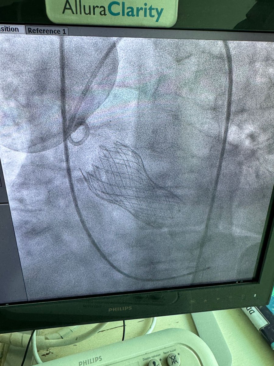 Dr_Vivekakumar's tweet image. First in Max Hospitals (Across India) Pre-Mounted Ready To Use Vienna TAVI

Contact:- +918802024222

#viennatavi #cardiaccare #medicalinnovation #tavisystem #minimallyinvasive #medicalmilestone  #maxhospitalsaket #heartspecialist #drvivekakumar #cardiologist #cardiologistdelhi