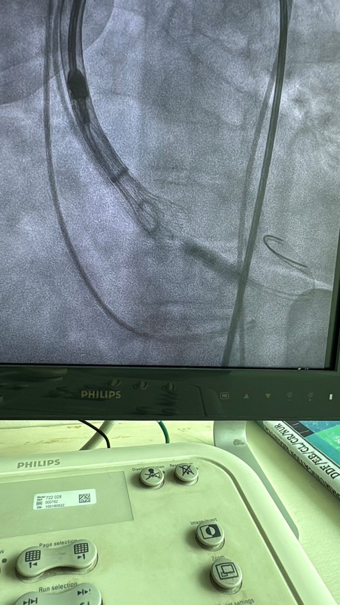 Dr_Vivekakumar's tweet image. First in Max Hospitals (Across India) Pre-Mounted Ready To Use Vienna TAVI

Contact:- +918802024222

#viennatavi #cardiaccare #medicalinnovation #tavisystem #minimallyinvasive #medicalmilestone  #maxhospitalsaket #heartspecialist #drvivekakumar #cardiologist #cardiologistdelhi