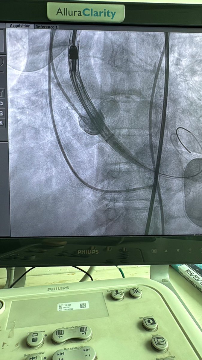 Dr_Vivekakumar's tweet image. First in Max Hospitals (Across India) Pre-Mounted Ready To Use Vienna TAVI

Contact:- +918802024222

#viennatavi #cardiaccare #medicalinnovation #tavisystem #minimallyinvasive #medicalmilestone  #maxhospitalsaket #heartspecialist #drvivekakumar #cardiologist #cardiologistdelhi