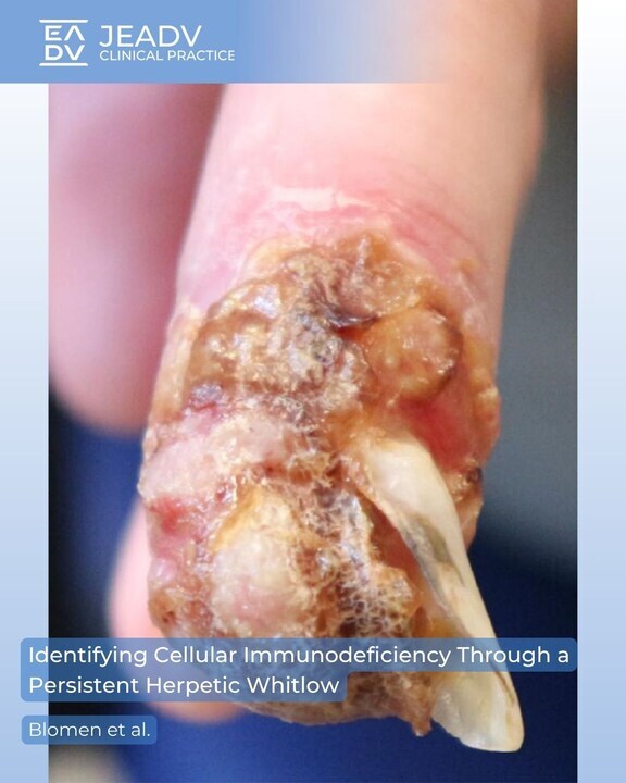 Cutaneous #HSV can appear atypically in #immunocompromised #patients. 
Blomen et al. report chronic herpetic whitlow (HSV-2) &amp; herpes zoster in a patient with severe CD4+ deficiency. 
#HIV #diagnosis was delayed by stigma; treatment restored immunity.

👉 bit.ly/3JjMlmJ