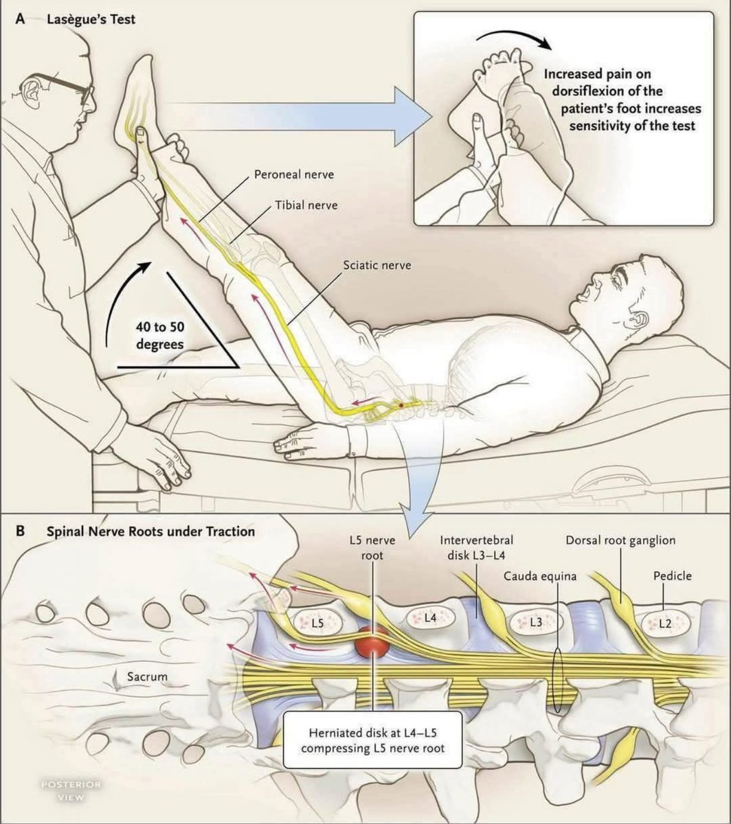 Straight leg raise or Lasegue’s test is a simple bedside test for sciatica (L4–S1 nerve compression from a herniated disc). Worsening pain on dorsiflexion of the foot is known as Bragard’s sign and helps to increase test accuracy. 

📸: nejm.org/doi/full/10.10…