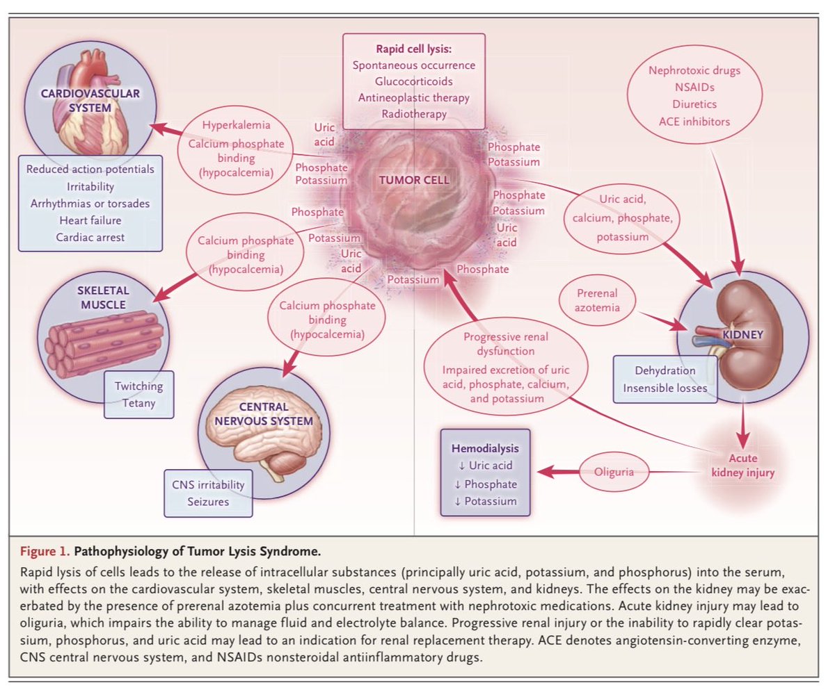 hardik4u24's tweet image. ⚡️Tumor Lysis Syndrome (#TLS): rapid tumor breakdown→ electrolyte &amp;amp; metabolic chaos

Risks:
🔹HyperK, hypoCa, hyperPhos, ↑ uric acid
🔹AKI, arrhythmias, seizures
🔹Chemo, steroids, RT

Early recognition &amp;amp;RRT save lives

🔗doi.org/10.1056/NEJMra…
#Nephrology #OncoNephrology #AKI