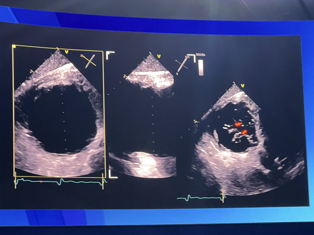 hzanellamd's tweet photo. Amazing lecture on TTEER screening by @lsanchisruiz  #echofirst https://t.co/PdcuYJC7pX