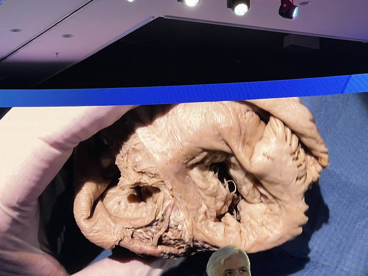 hzanellamd's tweet photo. Amazing lecture on TTEER screening by @lsanchisruiz  #echofirst https://t.co/PdcuYJC7pX