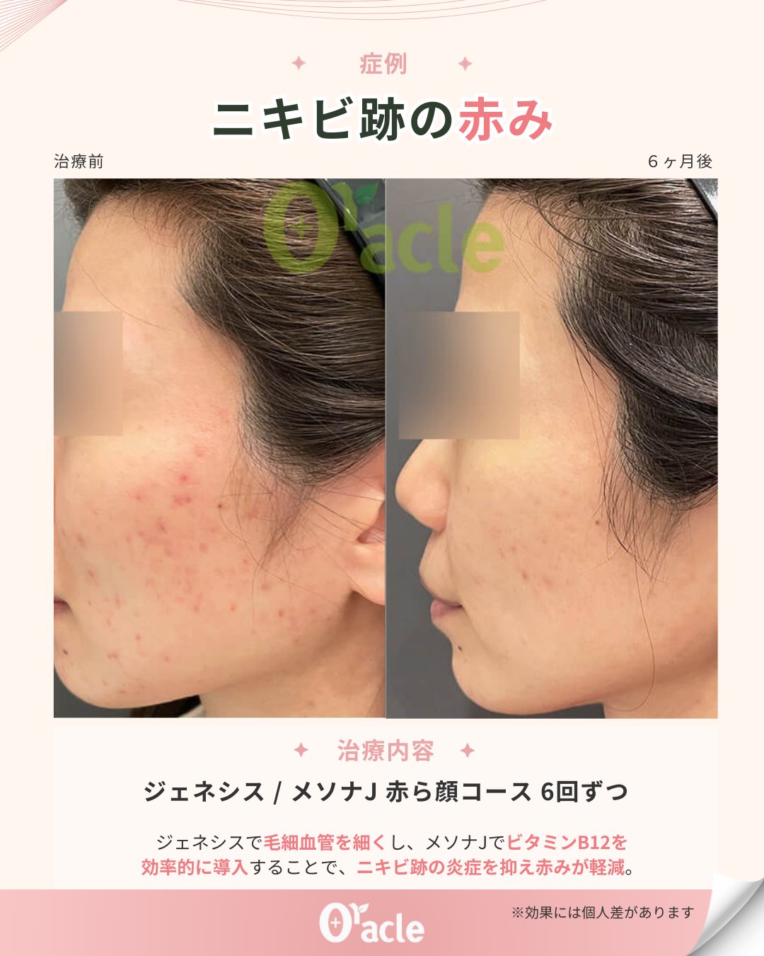 Oracle美容皮膚科と同じものです✴︎ Oracle美容皮膚科と同じものです✴︎ オラクル美容皮膚科【公式