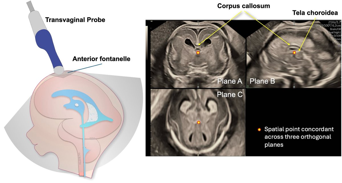 The fetal brain neurosonography in trisomy 21: the seagull sign and thinned subplate - Multiplanar navigation through anterior fontanelle in transvaginal 3D neurosonography ow.ly/Ns2Q50WZhVr