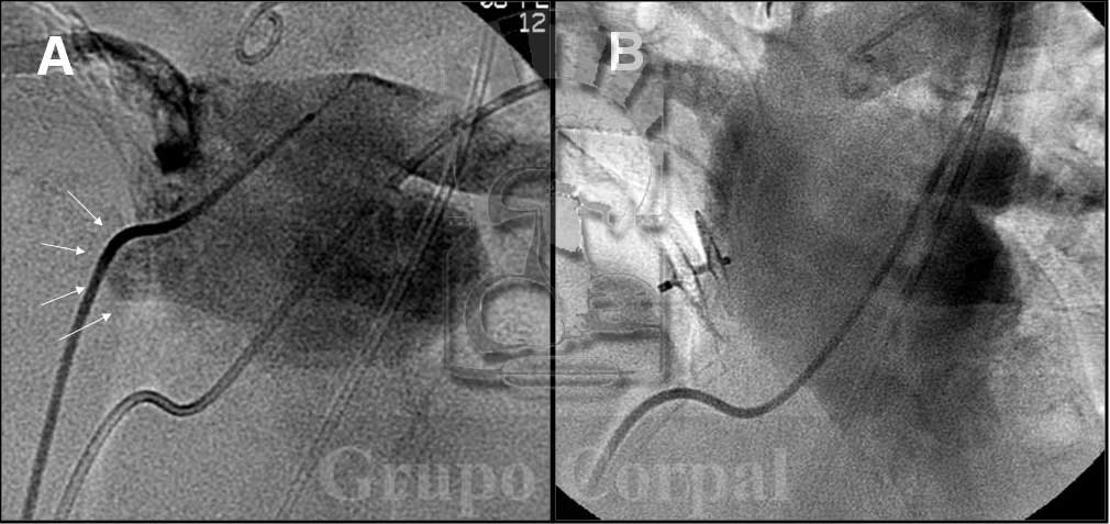 ℹ️Te contamos qué es el FOP (Foramen Ovale Permeable) y cómo se lleva a cabo su tratamiento 
#cardiopatiascongenitas #FOP #Cardiologia

acortar.link/sInp92