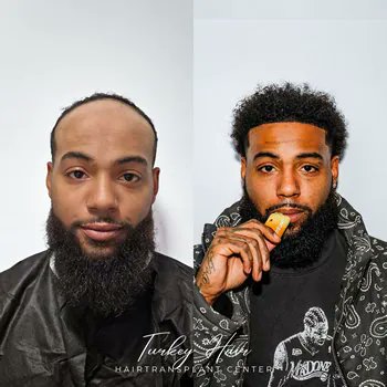TurkeyHairCentr's tweet photo. Natural and Permanent Solutions: Hair Transplant in Turkey

Hair loss is one of the most common problems affecting both men and women, often leading to a loss of confidence. 
Visit Us:https://t.co/O8QKma0oLT https://t.co/jR2v5Yo033