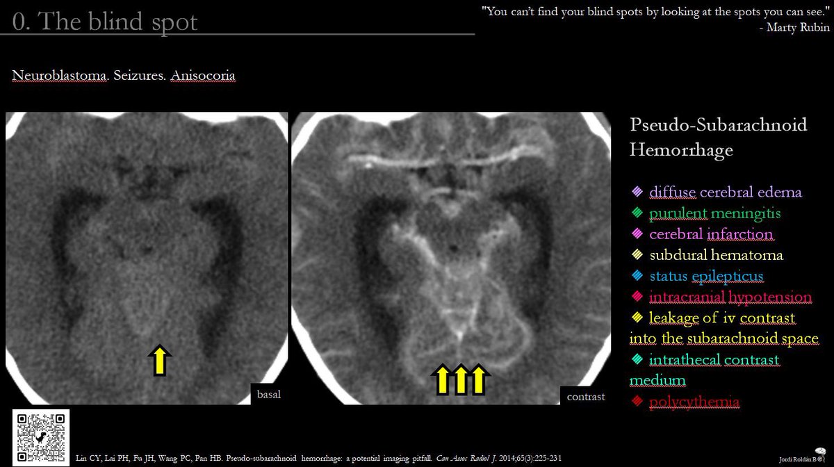 🔊SPIN-ECHO: same scenario, more beneath the surface. Looks like blood, but it’s not—pseudo-SAH in neuroblastoma with CNS involvement.

Without context, we oversimplify.