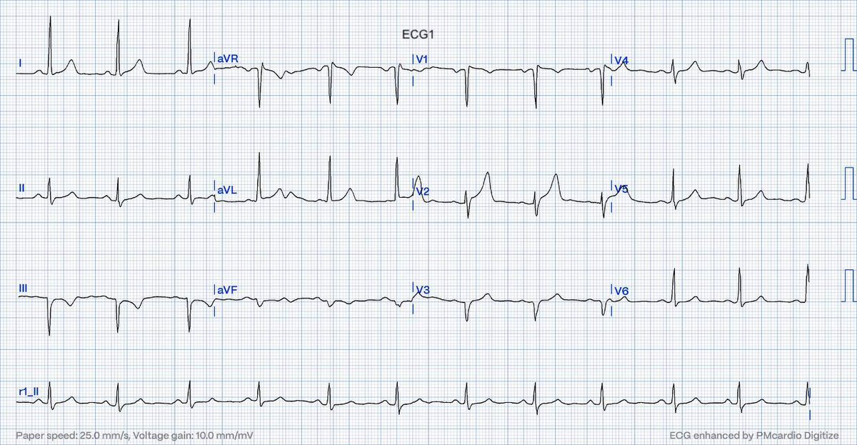 EcgOxford's tweet image. Typical CP
Ctnl 0.02ng/mL
HsTn 19ng/L
Dx?
@akneton @yolyabreuh @UlhasDr @DidlakeDW @ecgrhythms @IhabFathiSulima @DrPharmDMDTh @Vadeboncoeur_Al @smithECGBlog @EM_RESUS @estudiomedicina @OrlandoRPN @fxgodzeuss #EPeeps #FOAMcc @ResusMed @TrRja @NaokiThukishima
@ecgandrhythmRoe