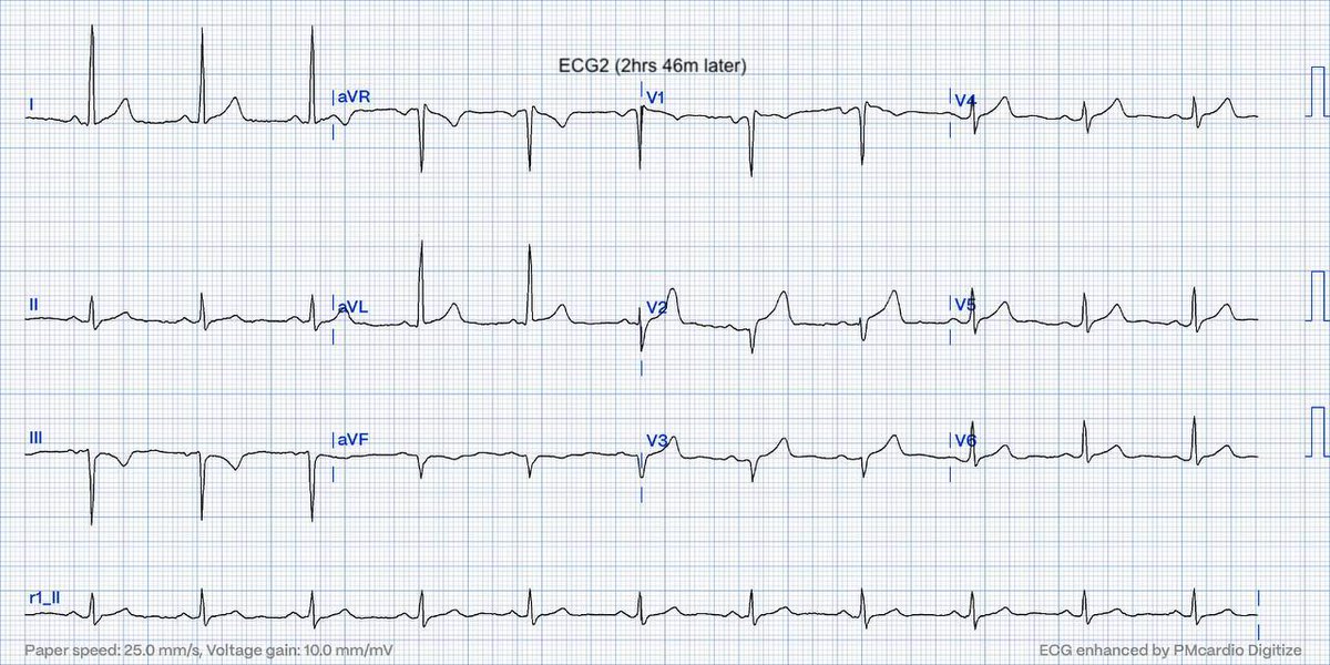 EcgOxford's tweet image. Typical CP
Ctnl 0.02ng/mL
HsTn 19ng/L
Dx?
@akneton @yolyabreuh @UlhasDr @DidlakeDW @ecgrhythms @IhabFathiSulima @DrPharmDMDTh @Vadeboncoeur_Al @smithECGBlog @EM_RESUS @estudiomedicina @OrlandoRPN @fxgodzeuss #EPeeps #FOAMcc @ResusMed @TrRja @NaokiThukishima
@ecgandrhythmRoe