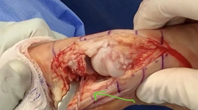 The phrase “Turf toe” doesn’t reflect the severity of injury and how disabling it can be. It involves a tear of the planter plate of the big toe. With instability here, it becomes impossible to  “toe off” with any significant strength. This is critical for running and throwing.