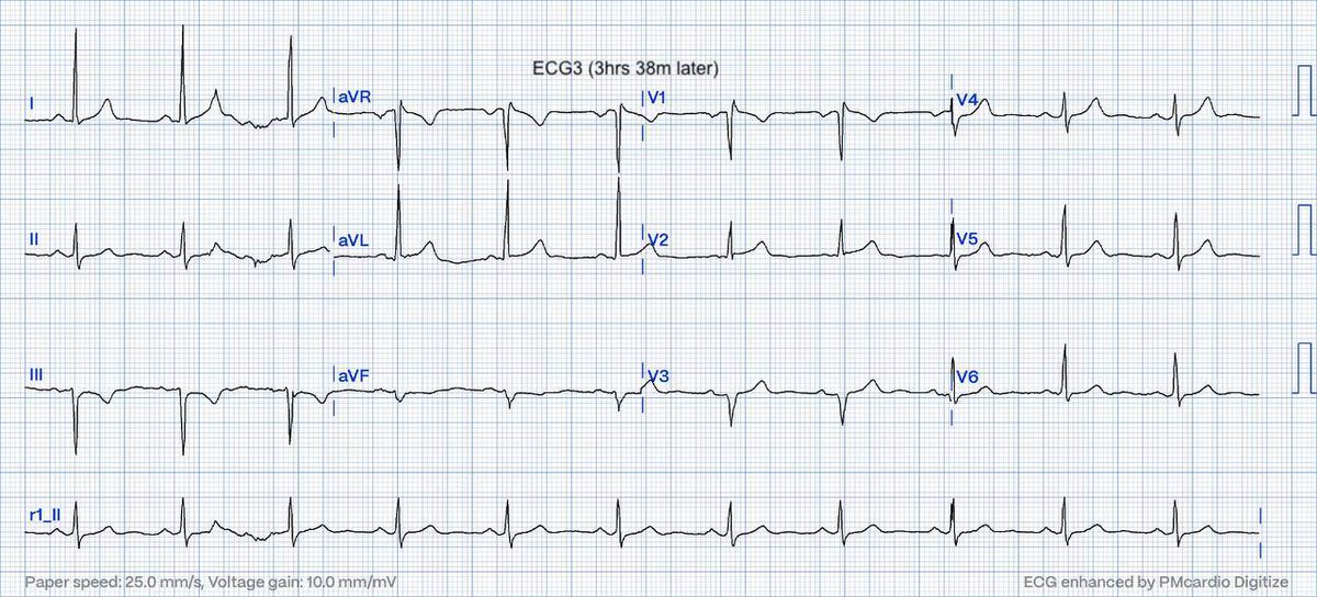 EcgOxford's tweet image. Typical CP
Ctnl 0.02ng/mL
HsTn 19ng/L
Dx?
@akneton @yolyabreuh @UlhasDr @DidlakeDW @ecgrhythms @IhabFathiSulima @DrPharmDMDTh @Vadeboncoeur_Al @smithECGBlog @EM_RESUS @estudiomedicina @OrlandoRPN @fxgodzeuss #EPeeps #FOAMcc @ResusMed @TrRja @NaokiThukishima
@ecgandrhythmRoe