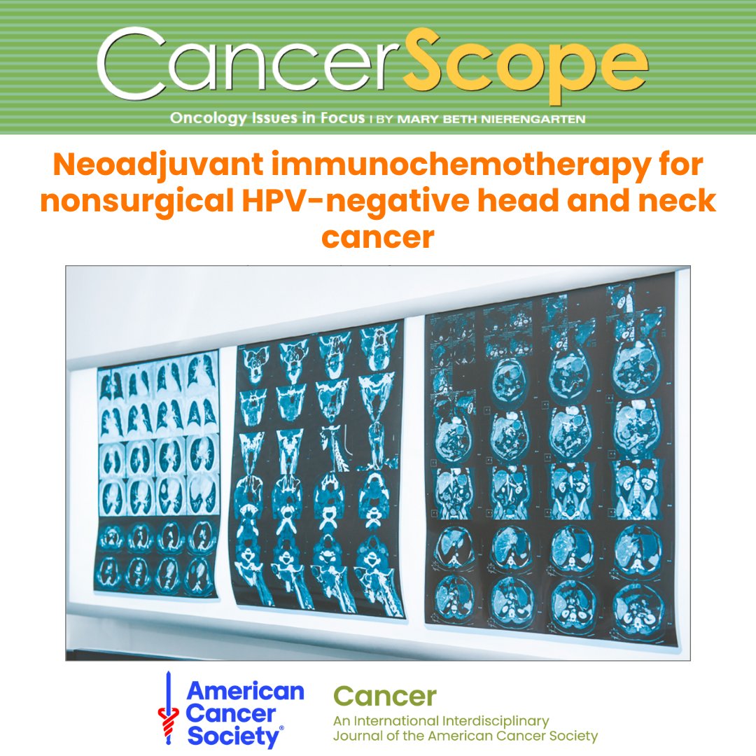 Read free in #CancerScope: A phase 2 trial in JAMA Oncology finds people with nonsurgical HPV-negative head &amp; neck cancer may benefit from pre-radiation immunochemotherapy + chemo.

💊 86% saw tumor shrinkage
⚖️ Potential fewer side effects

🔗 acsjournals.onlinelibrary.wiley.com/doi/full/10.10…

<a href="/OncoAlert/">OncoAlert</a>