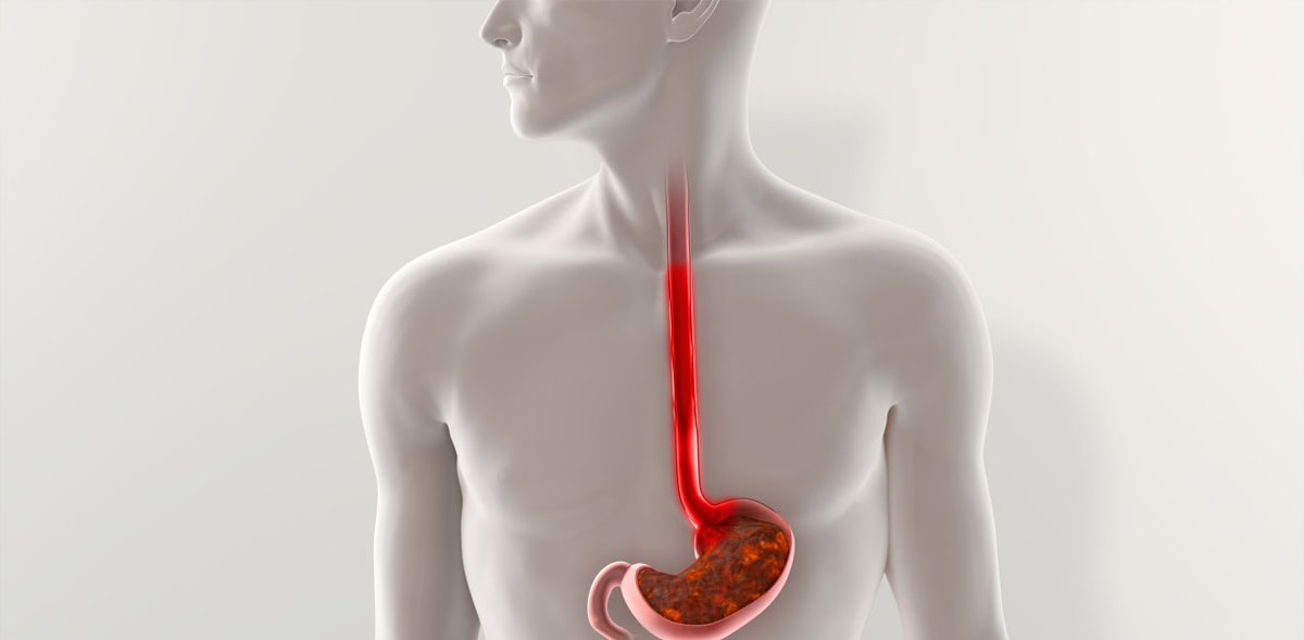 Acid reflux and your ears? 👂

New genetic study links GERD to hearing loss, tinnitus, and balance disorders — but no ties for Barrett’s esophagus.

Read the full story: ow.ly/r1tm50WWUbE

#GERD #HearingLoss #MedicalResearch #Conexiant