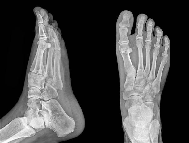PodiatryMarket's tweet photo. Your feet hold 26 bones + 33 joints—over 25% of your skeleton—all in a space smaller than a basketball. One bad landing in hoops or soccer can trigger micro-fractures that linger for seasons. Build resilience with proprioception drills. #FootPower #SportsScience https://t.co/bhoZhOAqcu