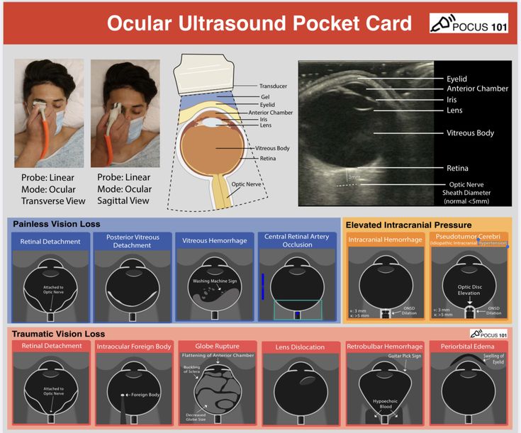 ocular ultrasound pocket card for quick reference on painless and traumatic vision loss, plus signs of elevated intracranial pressure. ​Do we have colleagues who perform ocular ultrasounds in ophthalmology clinics, and what common diseases do you encounter?
#ultrasound_sonologist