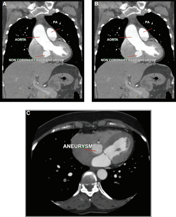 💓 Sinus of Valsalva aneurysm (SOVA) is rare but dangerous if ruptured.

📌 Case series of 3 patients:

CT enabled early diagnosis
Surgical repair led to full recovery
No postop complications, restored heart function

👉 Timely imaging + surgery = lifesaving outcomes.

Read more