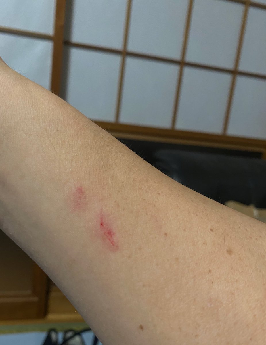 shibuya396's tweet photo. 田舎への帰省中、後輩ヤンキーに絡まれ、殴る引っ掻く等の暴行を加えられました。（私は一歳抵抗しておりません。）
友人のバーが閉店との事で「お疲れ様」の意味を込めて田舎へ帰省したため、気が引けて警察に被害届は出してないです。
また、都内在住で明日帰省予定です。
どうしたら良き？ https://t.co/Ds6HvvhOWy