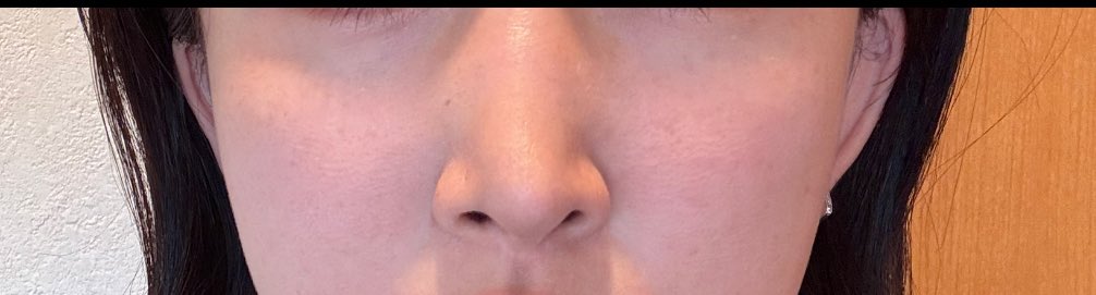 10/20-10/29渡韓します🇰🇷
被る方ご飯とか散歩とか行きませんか？DMください❣️
<a href="/and_ps_jp/">韓国🇰🇷👃🏻鼻専門医👃🏻AND(エンド)整形外科</a> エンド整形外科で鼻修正
<a href="/fact_psjp/">ファクト整形外科</a> ファクト整形外科で涙袋脂肪移植+目の下脂肪再配置（予定）
あとは肌管理とか適当にやりますー！立ち耳フィラーもしたい
さて私の曲がった鼻はどうなるやら😮‍💨