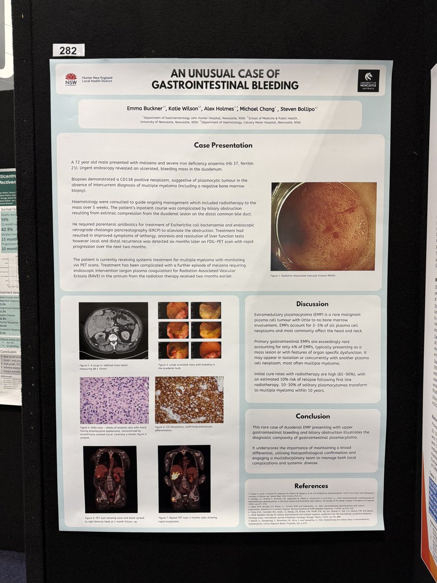 stevenbollipo's tweet photo. Extramedullary plasmacytoma causing duodenal bleeding ๐ฉธ
Our poster at #WCOG25 #WCOG_AGW25 https://t.co/xT7KLTHjPm