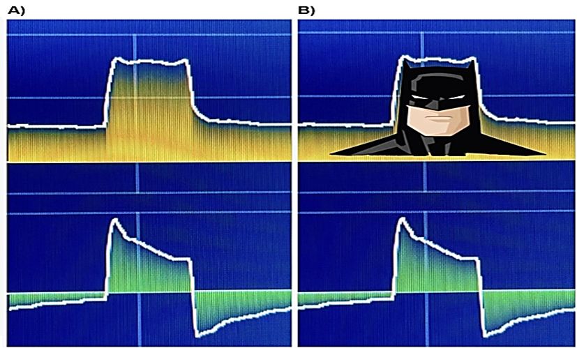 The Batman sign: Graphical representation and pedagogical strategy for teaching ventilator asynchronies 
journalmechanicalventilation.com/2025-september…