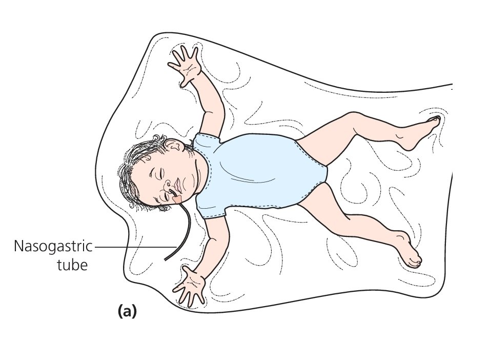 9 month old infant was given honey.

What happened here❓️