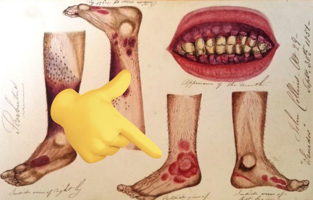 drabdulhameed07's tweet photo. 🚨 Which vitamin deficiency?
A) Vitamin A
B) Vitamin C
C) Vitamin D
D) Vitamin K
#Gumbleeding #MedX #MedTwitter https://t.co/IY7eH5YW84