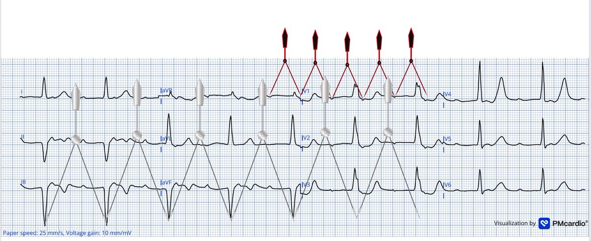 <a href="/sohrab1104/">Sohrab Ayoubi</a> <a href="/Ecgloverr/">Pedram</a> <a href="/The_Nanashi_O/">Nanashī🫀</a> <a href="/Ahmedata7777/">Ahmed Ata</a> <a href="/AbdulazizM2669/">Abdulaziz Mosleh</a> <a href="/DrRazi4/">Dr Razi</a> <a href="/ECGWeekly/">ECGWeekly</a> <a href="/Frances98392343/">Cciari1</a> <a href="/FibrilloFlutter/">FLUTTER</a> I think it is CHB = AVB III, two different rhythm (atria and ventricles), dissociated.