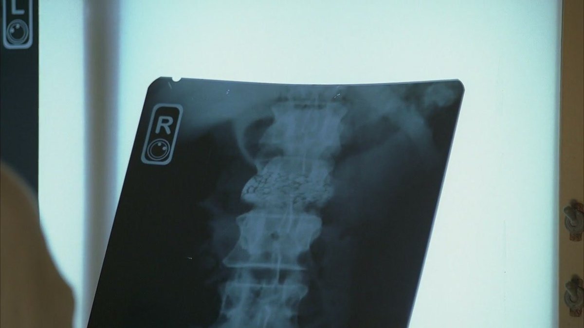 Juliet finds out Ben has a large tumor on his spine