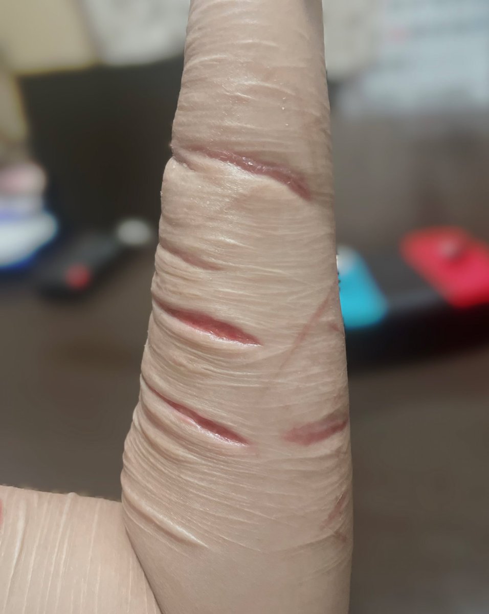 ammmn009's tweet photo. #selfharm  ぼっこぼこ https://t.co/8nNiXLv2aE