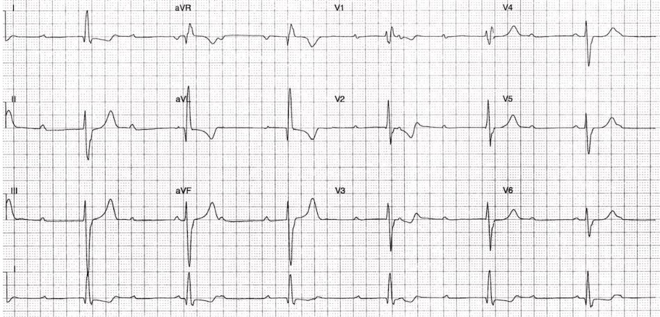 #気まぐれ心電図クイズ
〘その28〙

失神で来院

次の中で最も可能性が高いのはどれでしょうか？🤔

1️⃣３枝ブロック
2️⃣心室補充調律は左脚前枝起源
3️⃣Wenckebach型Ⅱ度房室ブロック
4️⃣不整脈原性右室心筋症
5️⃣心サルコイドーシス