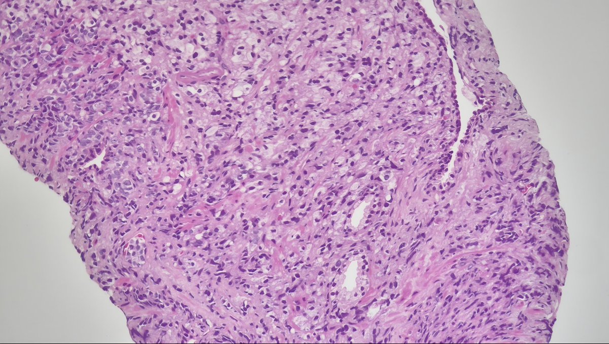 byrk_bsr's tweet photo. 66 yo male, PSA 228
Prostate tru-cut biopsy
IHC: Chromogranin, Synaptophysin
Thoughts? 🤔
#Uropathology #PathTwitter #GenitourinaryPathology
@GU_Path_Society @IntSocUropath https://t.co/N8qrgSNakk
