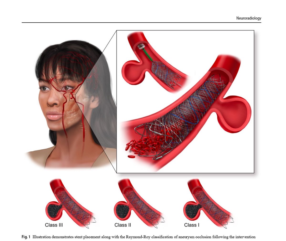 Now online <a href="/NRADjournal/">Neuroradiology</a>! 
FRED-X for aneurysms achieved 86% occlusion, &lt;1% mortality, and 1.2% stenosis. 
Grateful to our incredible team! <a href="/Starkeneurosurg/">Starke_neurosurgery</a> <a href="/AmirHFaraji/">Amir Faraji, MD, PhD</a> <a href="/RahmaniRedi/">Redi Rahmani</a> <a href="/DavidAltschulMD/">David Altschul</a>  <a href="/AlexHoangMD/">Alex Hoang</a> <a href="/MAEssibayi/">Muhammed Amir Essibayi, MD MSc</a> <a href="/KTaghlabi/">Khaled M. Taghlabi, MD</a> <a href="/terumoneuro/">Terumo Neuro</a>.
Link:link.springer.com/article/10.100…