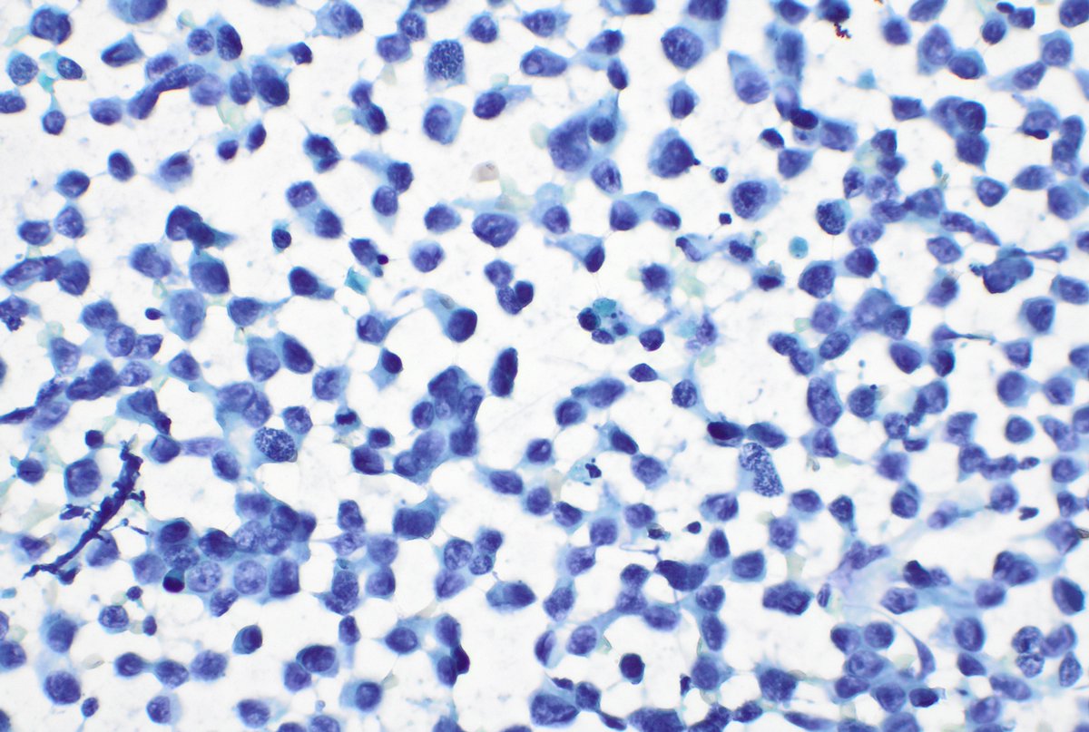 And for this weekend three different moments of breast cytology.  See you in October ¡¡🥰❤️  <a href="/citologiala/">citologiala</a> <a href="/SECitologia/">Sociedad Española de Citología</a>