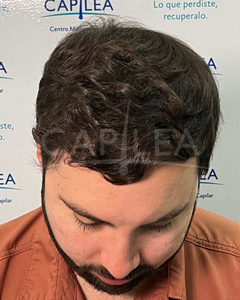 Aviso COFEPRIS 2319012002A00017
#drhectortreviño #capilea #capileamonterrey #hairtrasplant #injertocapilar #microinjertocapilar  #fuetechnique #trasplantecapilar   #capileatijuana #capileacdmx #drhectortrevino #capileamexico #hairtrasplantsurgeon