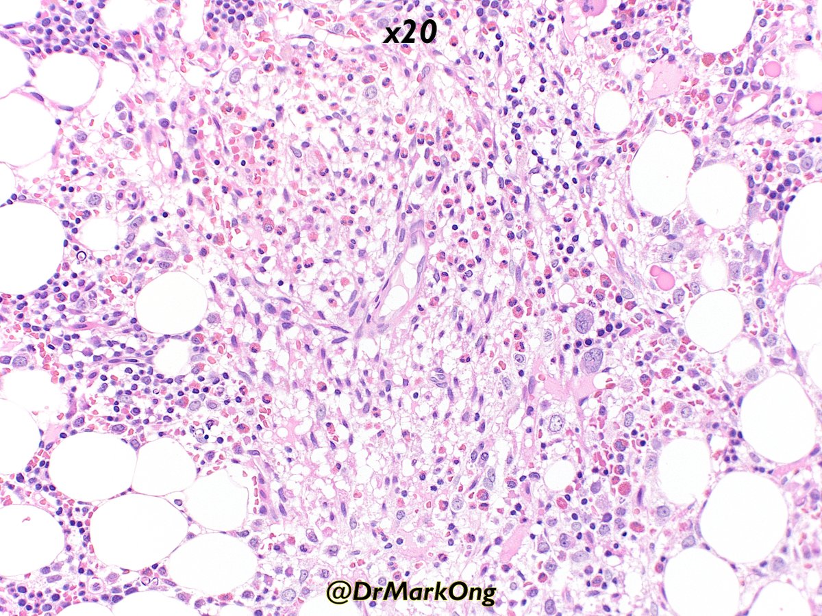 DrMarkOng's tweet photo. Adult previously treated for B-cell lymphoma. Mild cytopaenia. Bone marrow trephine biopsy taken to look for possible relapse.

What's the diagnosis?

#hemepath #pathX https://t.co/McjJ1xMpV4