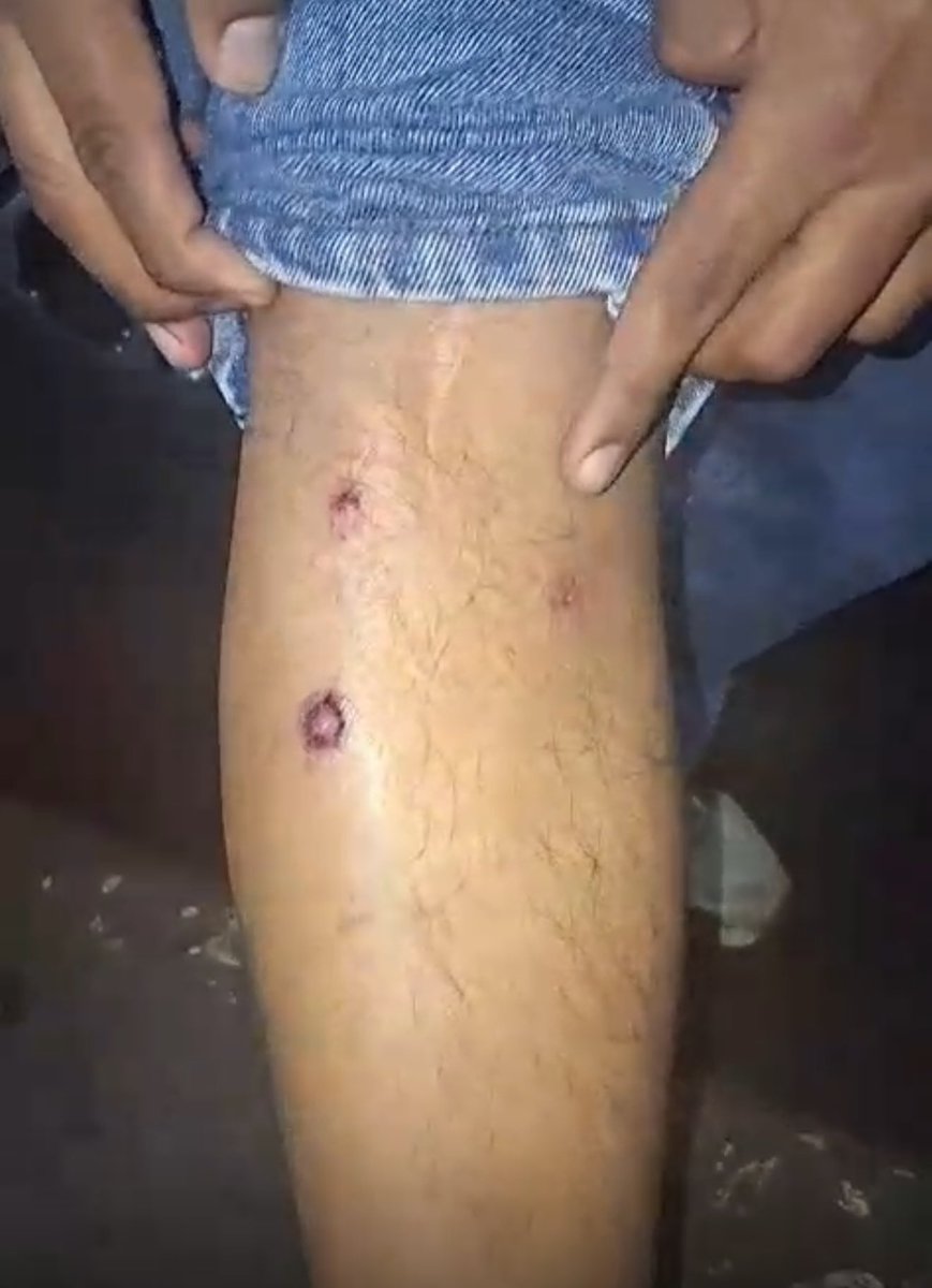 jesusverdeL's tweet photo. Un equipo de @exitosape  fue impactado por perdigones que la @PoliciaPeru lanzó contra manifestantes en el centro de Lima. Reportera y camarógrafo han terminado con las piernas heridas y alguien tiene que responder por la agresión a profesionales que solo hacen su trabajo y que están plenamente identificados como prensa.