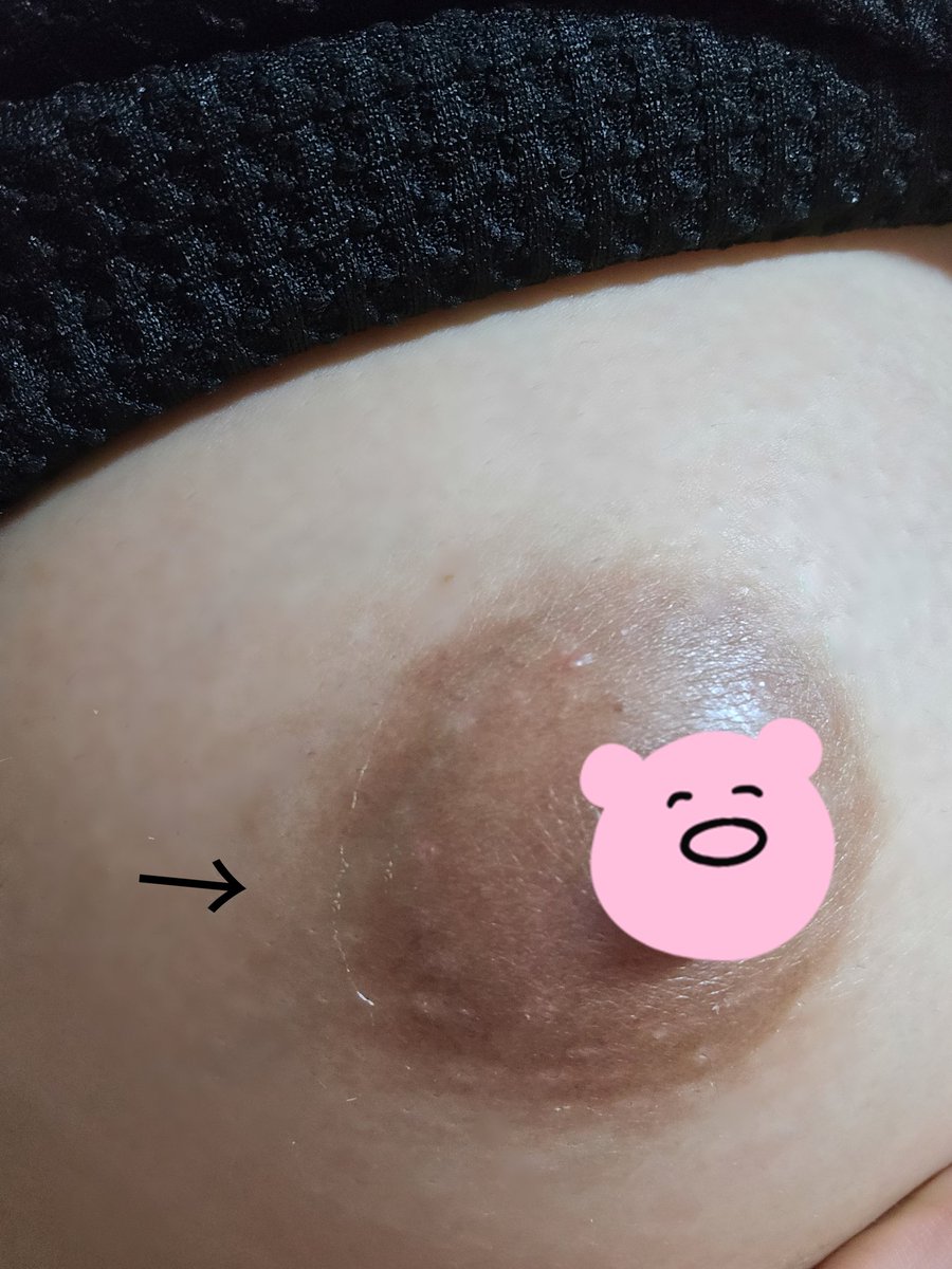 Mtaya_'s tweet photo. ローマピンク施術後12日でまだこれしか皮むけしてない😇ここから何とかなるのかな？アフタークリームが効果の7割って言われてるけど、剥離なしでここから効果ってでるのかな？それとも私の乳首のポテンシャルが低いのかな😇😇 https://t.co/ZTedbqeKCx