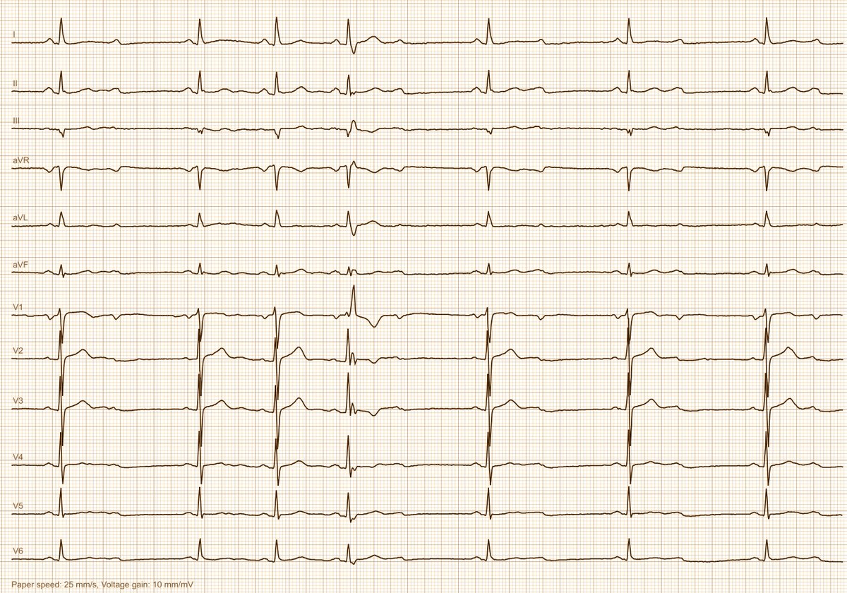 An elderly patient after near syncope, is he in trouble?
<a href="/Frances98392343/">Cciari1</a> <a href="/koggelnoggel/">Jana Borucka</a> <a href="/KostekMilan/">Milan Koštek</a> <a href="/XkeiT5stoD53218/">心電図が趣味</a> <a href="/Shahadomar_J/">شهد🫀.</a> <a href="/ghwamasoob/">-</a> <a href="/ThaierT13525/">Thaier Albreizat</a> <a href="/LeonrMail/">Leon</a> <a href="/PeterItebimien/">Itebimien Peter</a> <a href="/tbouthillet/">Tom Bouthillet</a> <a href="/EKGest/">Ecg</a> <a href="/OwnerOfALonelyH/">Aj</a> <a href="/IhabFathiSulima/">Dr Ihab Suliman</a> <a href="/DrparrayMD/">Drparray Mohammad</a> <a href="/AhmadGreenman/">Ahmad Greenman</a>