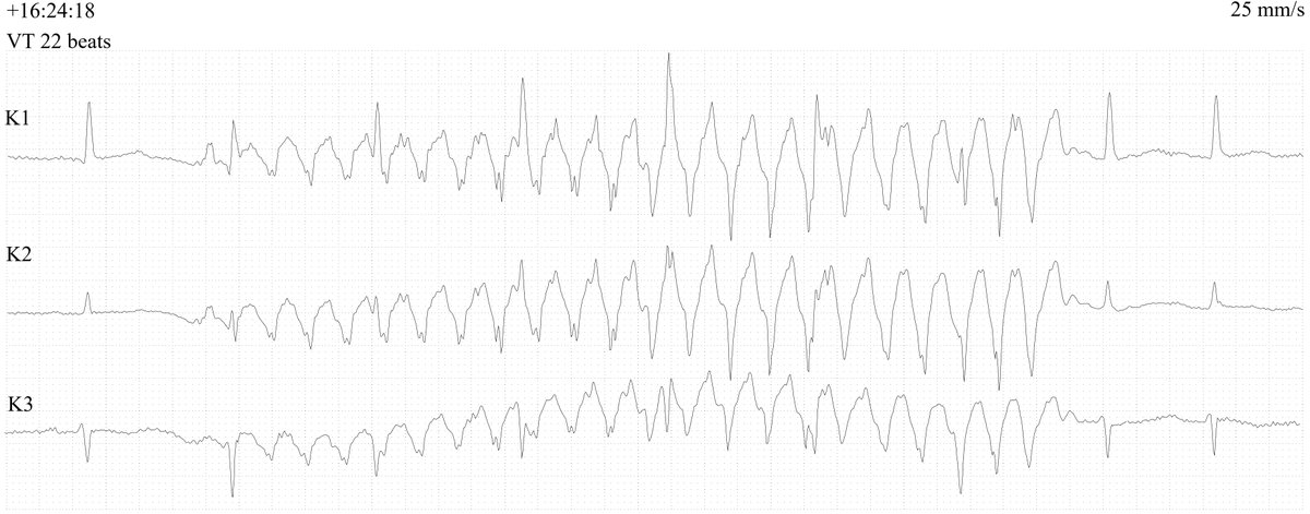 A patient with palpitations, Holter-strip 25 mm/s. Easy one for the experienced ECG reader. Please share this ECG! Evereybody should know this! <a href="/Jigarbuddhdev4/">Dr jigar</a> <a href="/Jagdish26039718/">Jagdish Singh</a> @PacingSpike <a href="/mohammadala33/">Mohammad Elidy</a> <a href="/JustusLimo/">Justus K Limo Mbugua🇰🇪</a> <a href="/hscott61/">hscott61</a> <a href="/TSM_Humanist/">Tariq Mir 🇵🇰</a>